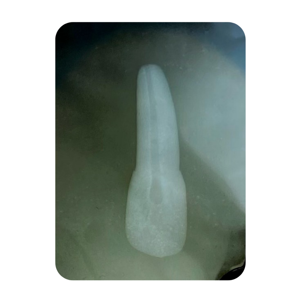 DENTE ENDO 22 RADIOPACO