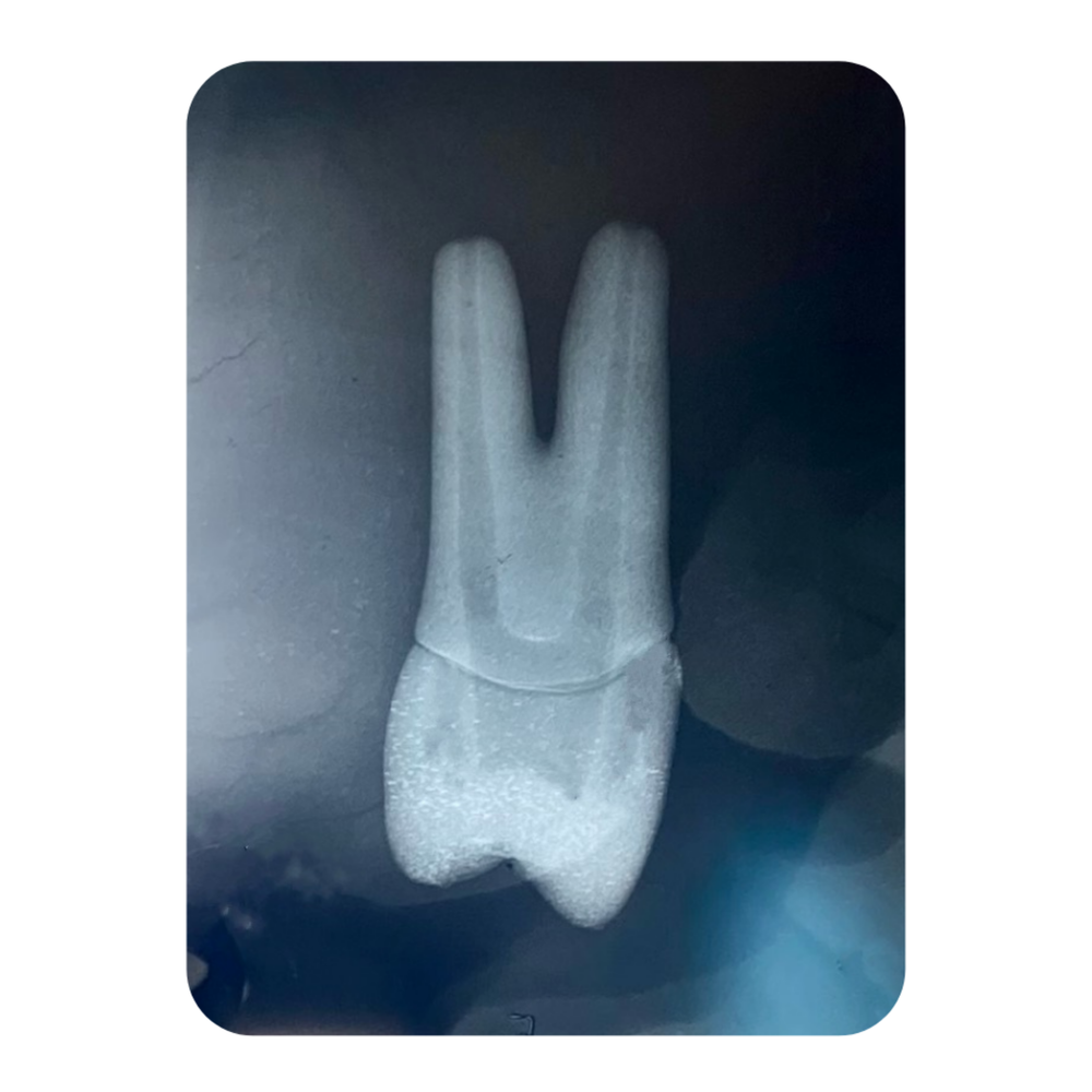 DENTE ENDO 24 RADIOPACO