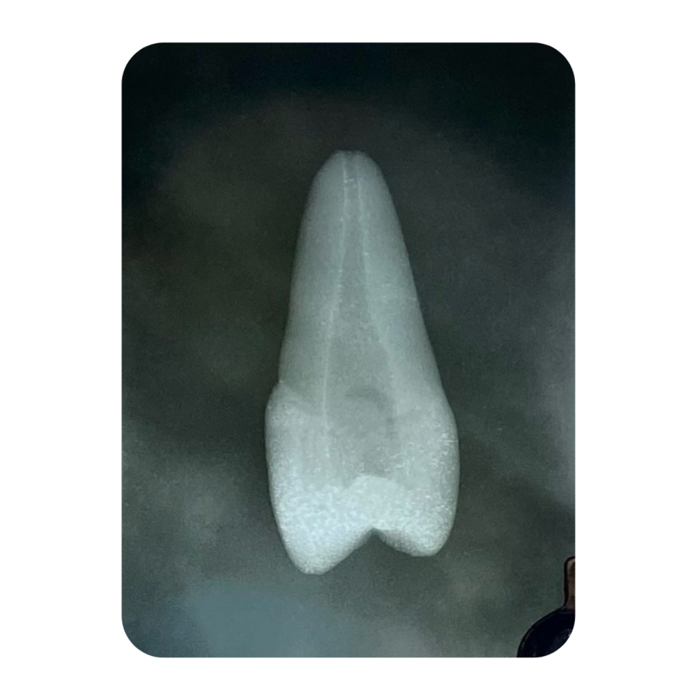 DENTE ENDO 25 RADIOPACO