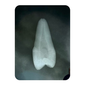 DENTE ENDO 25 RADIOPACO