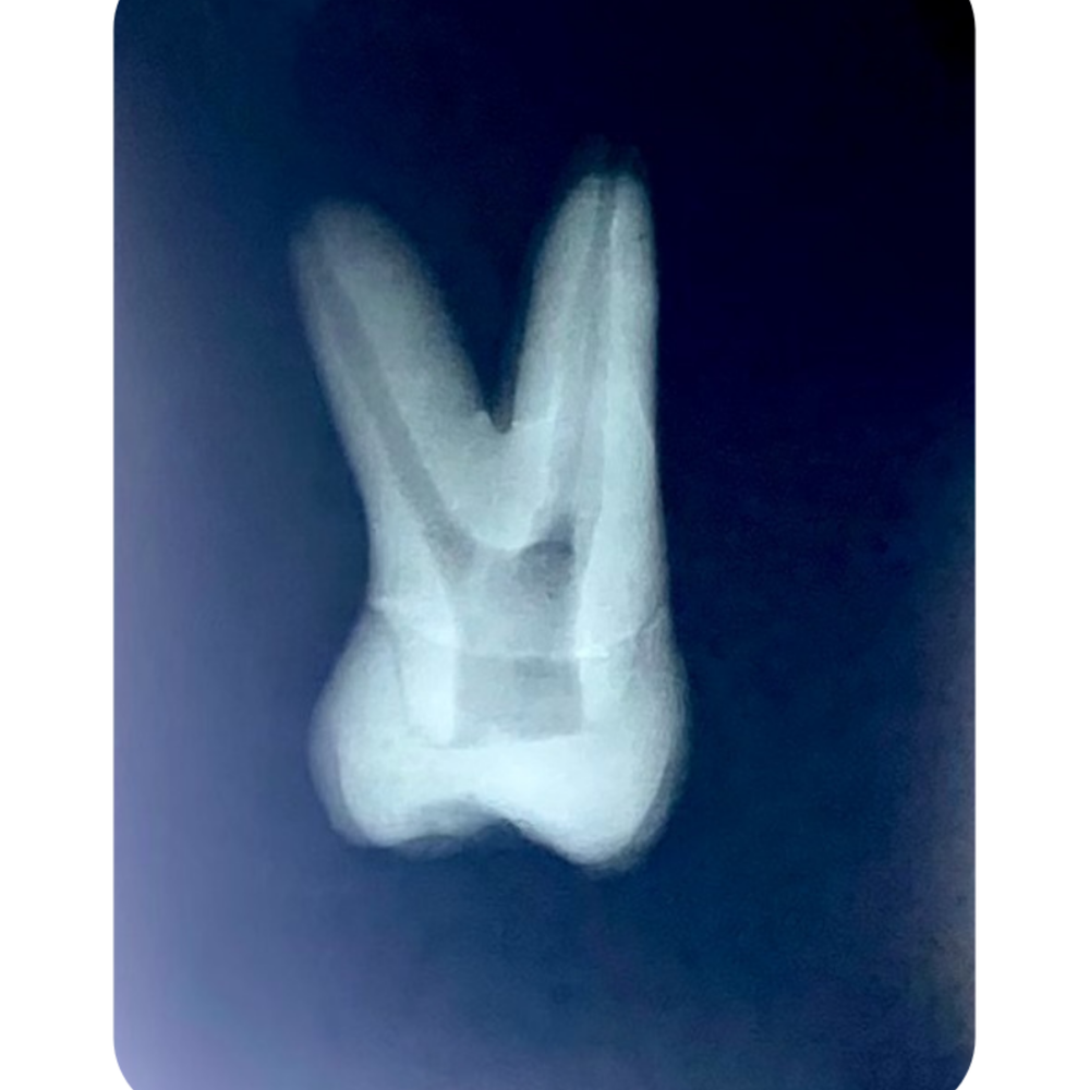 DENTE ENDO 26 RADIOPACO