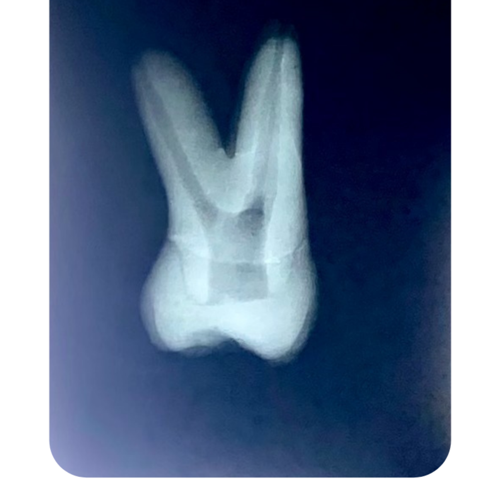 DENTE ENDO 27 RADIOPACO