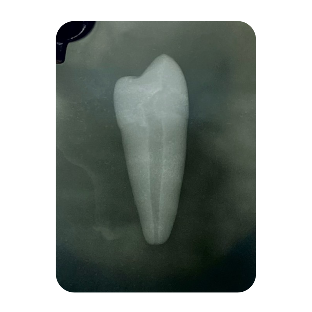 DENTE ENDO 34 RADIOPACO