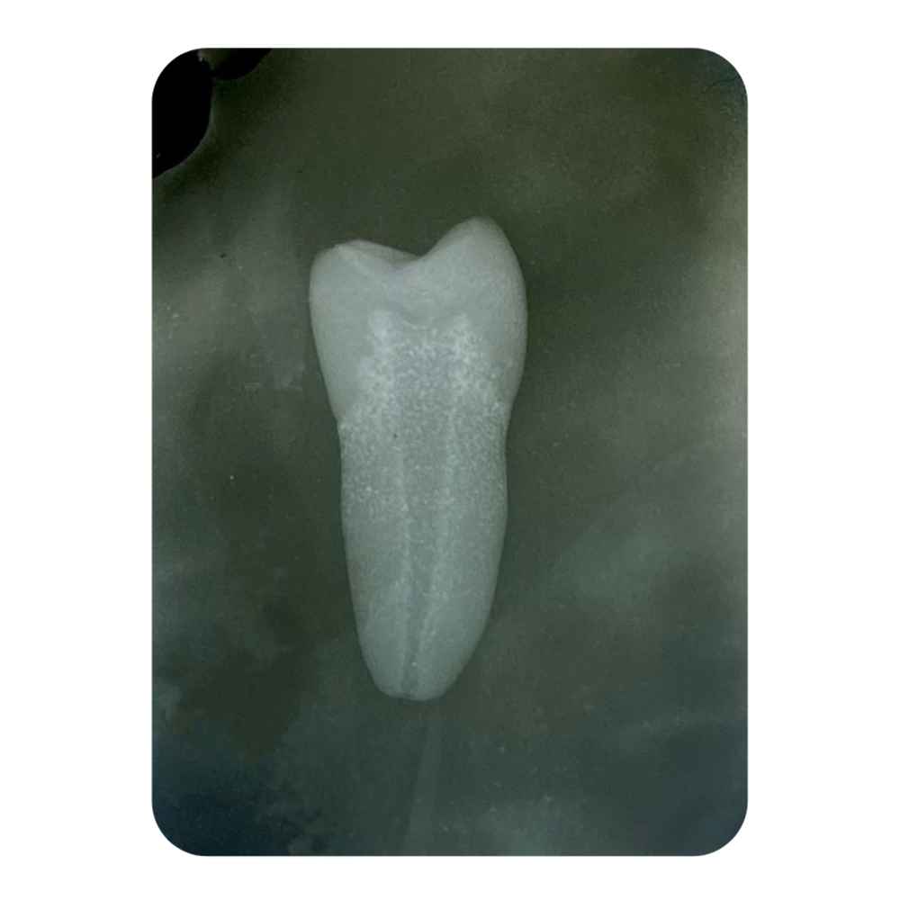 DENTE ENDO 35 RADIOPACO