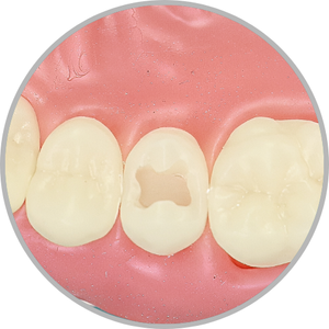 Dente 15 - Classe I (O) (cod:15.A)