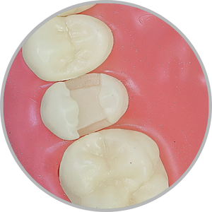 Dente 15 - Classe II MOD única (cod:15.B)