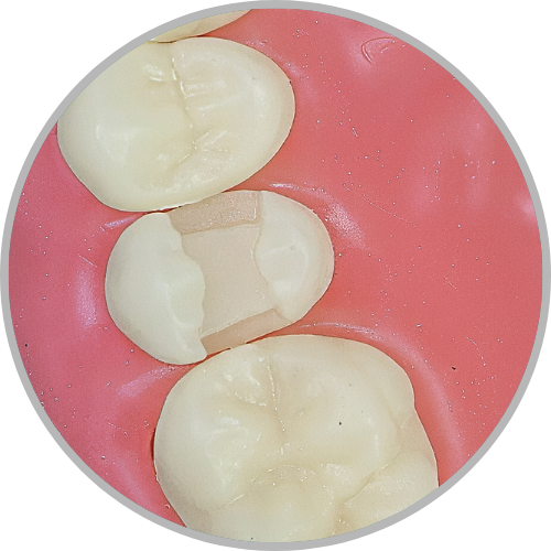 Dente 15 - Classe II MOD única (cod:15.B)