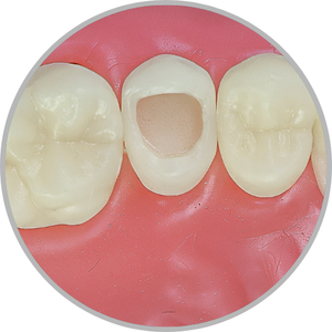 Dente 15 - Classe I (O) larga e profunda (cod:15.C)