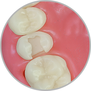Dente 15 - Classe II (OD) (cod:15.D)