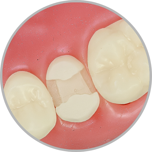 Dente 15 - Classe II (MOD) extensa com perda do terço oclusal das cúspides (V e P) (cod:15.E)