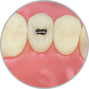 Dente 15 - Lesão de cárie classe I (O) (cod:15.F)