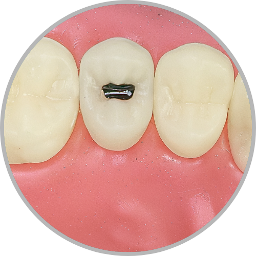 Dente 15 - Lesão de cárie classe I (O) (cod:15.F)