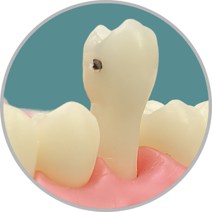 Dente 15 - Lesão de cárie classe II (MOD) cristas preservadas (cod:15.G)
