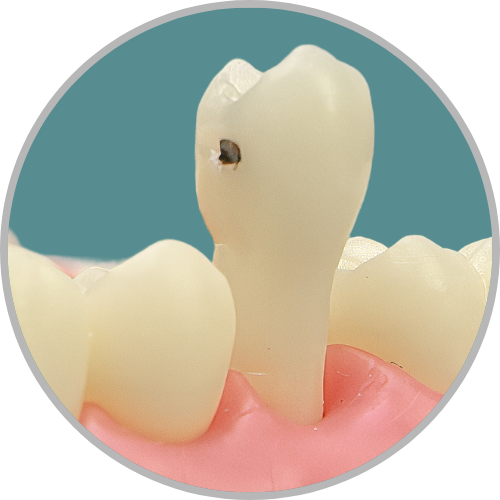 Dente 15 - Lesão de cárie classe II (MOD) cristas preservadas (cod:15.G)