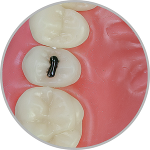 Dente 15 - Lesão de cárie classe II (MOD) cristas preservadas (cod:15.G)