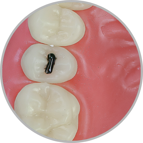Dente 15 - Lesão de cárie classe II (MOD) cristas preservadas (cod:15.G)
