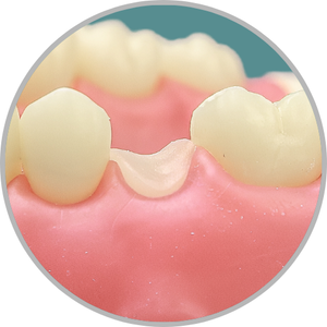 Dente 15 - Coto dental a nivel de gengiva (cod:15.H)