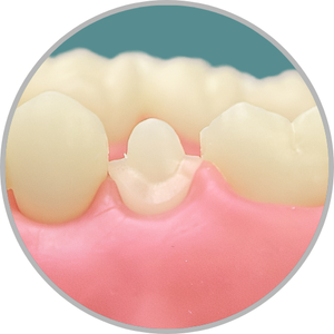 Dente 15 - Coroa total (cod:15.I)