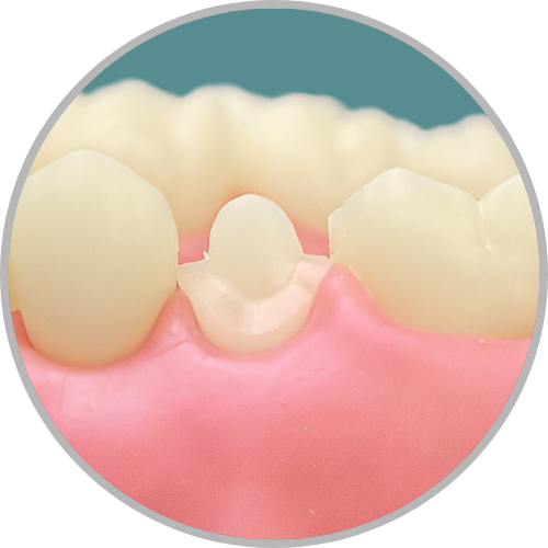 Dente 15 - Coroa total (cod:15.I)