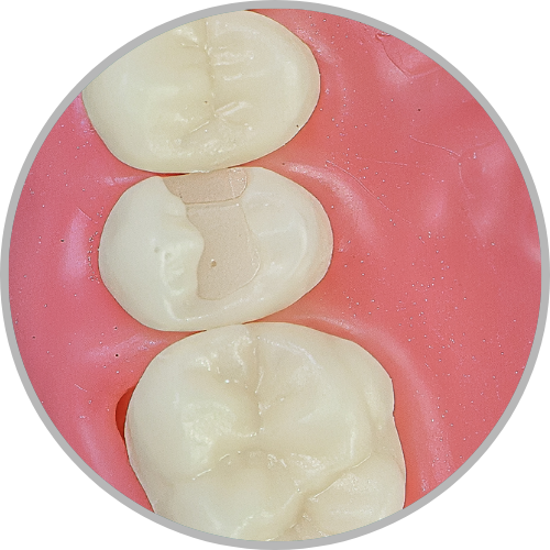 Dente 15 - Classe II (MO) (cod:15.J)