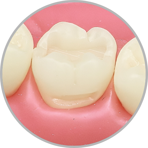 Dente 16 - Classe I (O) e Classe V (V e P) (cod:16.B)