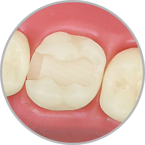 Dente 16 - Classe II (MO) (cod:16.D)