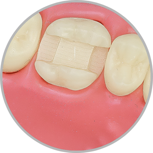 Dente 16 - Classe II (MOD) extensa (cod:16.F)