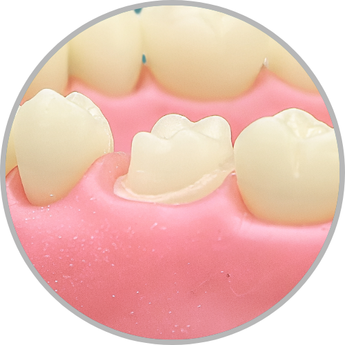Dente 16 - Coroa Total (cod:16.I)