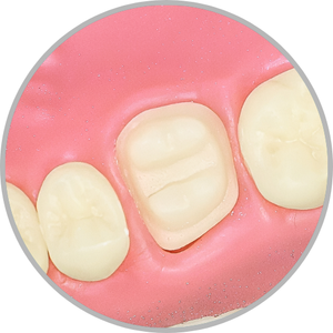 Dente 16 - Overlay (cod:16.J)