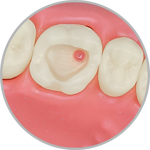 Dente 16 - Classe I (O) com exposição polpar (cod:16.K)