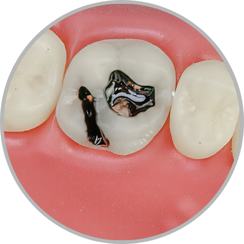 Dente 16 - Lesão de Cárie Oclusal, e ocluso palatino (preservado a ponte de esmalte) (cod:16.N)