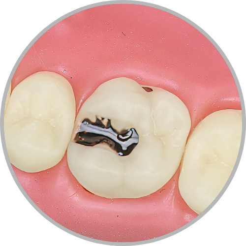 Dente 16 - Lesão de Cárie Mésio Oclusal, e palatina (esférica fim do sulco) (cod:16.O)