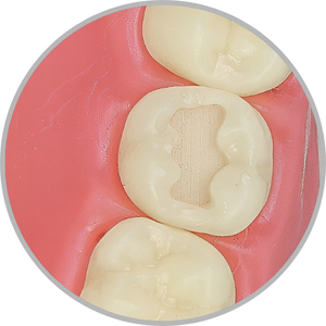 Dente 17 - Classe I (O) (cod:17.A)