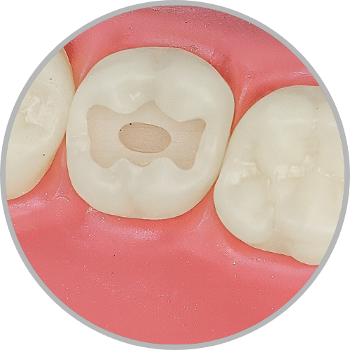 Dente 17 - Classe I (O) em duas profundidades (cod:17.B)
