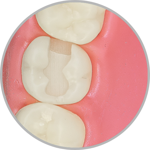 Dente 17 - Classe II (MO) (cod:17.D)