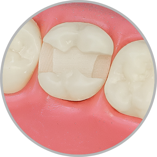 Dente 17 - Classe II (MOD) (cod:17.E)