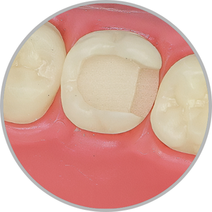 Dente 17 - Classe II (MO) ampla profunda (cod:17.F)