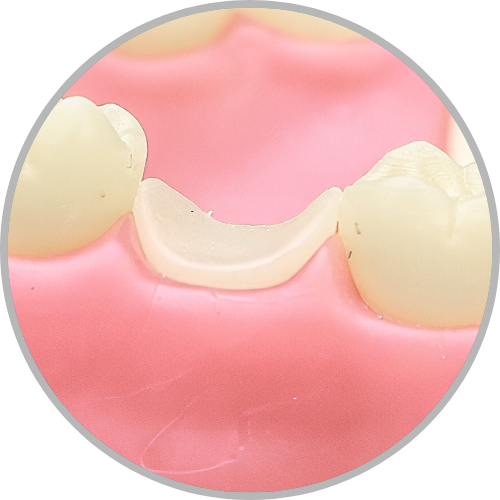 Dente 17 - Coto dental a nível de gengiva (cod:17.H)