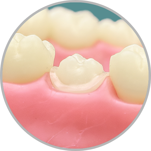 Dente 17 - Coroa Total (cod:17.I)