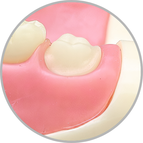 Dente 18 - Coroa Total (cod:18.C)