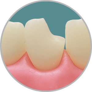 Dente 21 - Classe IV (M) extensa (cod:21.A)