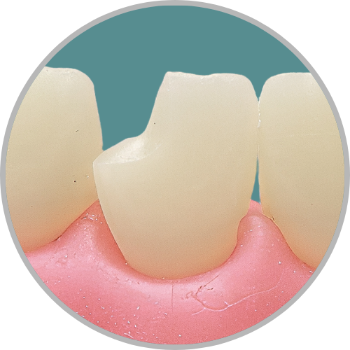 Dente 21 - Classe IV (D) (cod:21.B)