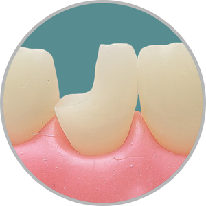 Dente 21 - Classe IV (D) (cod:21.B)