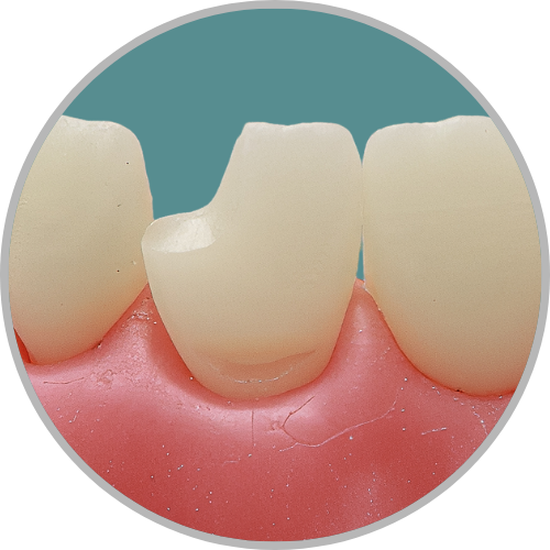 Dente 21 - Classe IV (D) e Classe V (V) (cod:21.C)