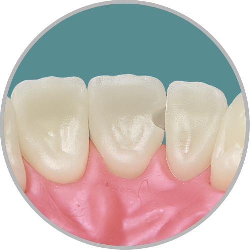 Dente 21 - Classe IV extensa (VDP) (cod:21.E)