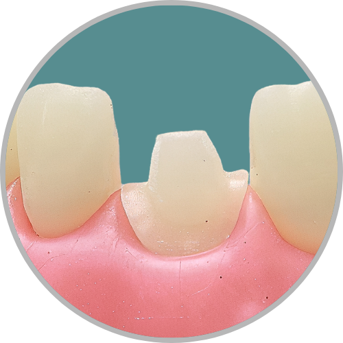 Dente 21 - Coroa Total (cod:21.I)
