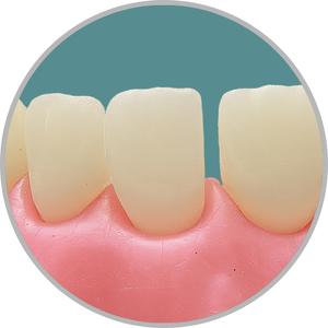 Dente 21 - Diastema mesial (cod:21.J)
