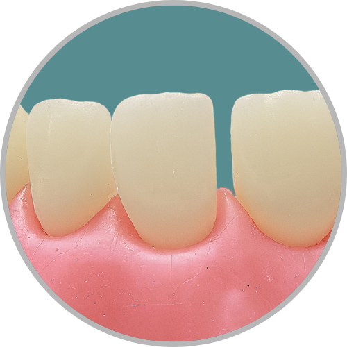 Dente 21 - Diastema mesial (cod:21.J)