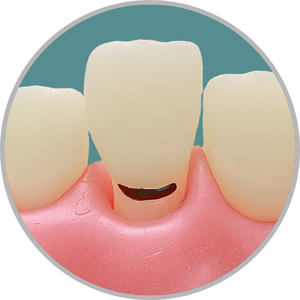 Dente 21 - Lesão de cárie subgengival vestibular (cod:21.K)