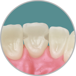 Dente 21 - Classe III (M) e (D) (cod:21.L)